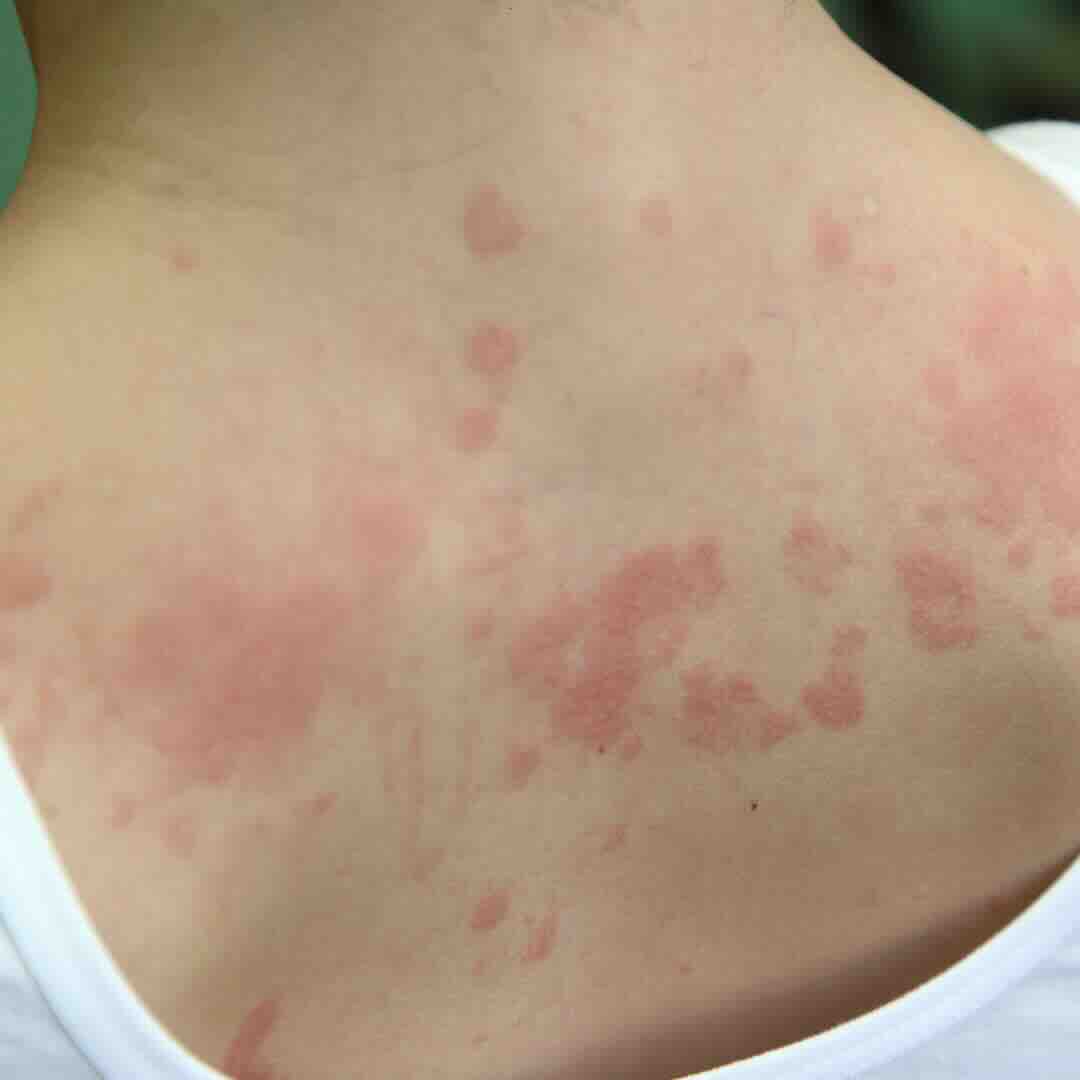 MCAS - Mast Cell Activation Syndrome 1